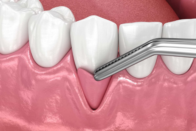Gum Surgery Procedure